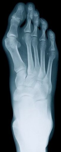 Wilton Podiatrist | Wilton Rheumatoid Arthritis | CT | WILTON FOOTCARE ASSOCIATES |